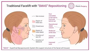 Face Lift & Mini Face Lift | Facelift Rhytidectomy Gold Coast