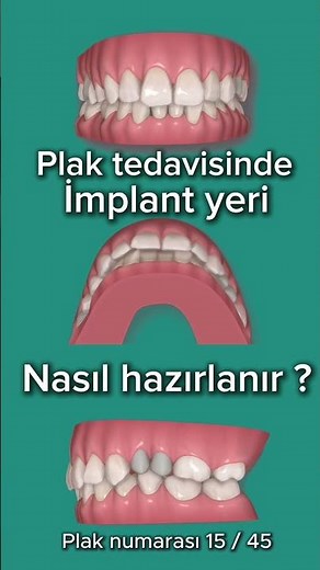 How to prepare the implant site in plaque treatment? #invisalign