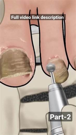 ASMR Satisfying ASMR Ingrown toenail removal treatment animation #asmr #2dasmr #relaxing #satisfying #fyp