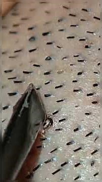 Extracting Large Blackheads Big Cystic Acne Blackheads&Whiteheads Removal Pimple Popping #49 #Shorts