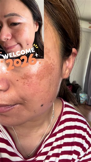 Melasma Treatment: Effective Korean Skincare Tips