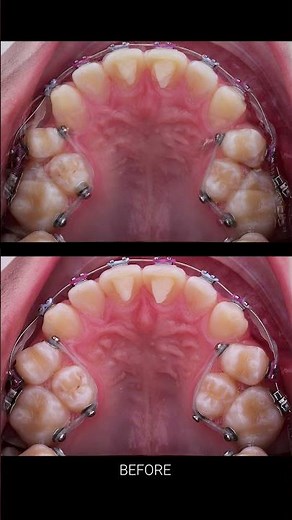 Braces process - crowded teeth