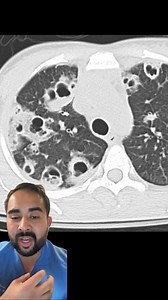 A toothache can be a sign of an abscess which is a serious life threatening infection ; go see a dentist immediately if you experience toothache | Ever Arias, MD