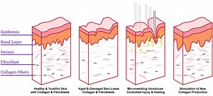 Micro Needling is rejuvenation and anti-aging treatment