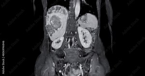 CT Abdomen show a retroperitoneal mass with a peripheral fatty component with thin septa and poorly defined solid-appearing areas with no clear demarcation between them and fat. Stock Video