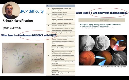 What level is a rendezvous DAE-ERCP with PTCD? 🤔 • Level V ERCP is defined as the utilization of novel or modified scopes, tools, devices, accessories, and techniques. • Level V ERCP is used to solve or remediate complex primary, secondary or iatrogenically-induced biliopancreatic tract disorders. • Examples include cholangitis in patients with stenosed esophagus and overtubes-assisted ERCP after complex neck surgery. For further examples and explanations, head over to EndoCollab | EndoCollab