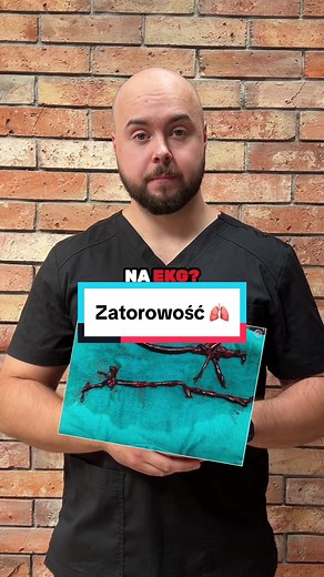 Jak zapamiętać zatorowość płucną? TRUDNO 😀 A wy znacie jakies fajne akronimy? 🤔 Piszcie w komentarzu 😀 #ekgpopolsku #naukaekg #ekg #kardiologia #arytmie #medycyna #studiamedyczne #studialekarskie #lekarski #lekarz #pielegniarka #ratownikmedyczy #ratownik #elektroradiologia #sor #zatorowść #zatorowoscplucna