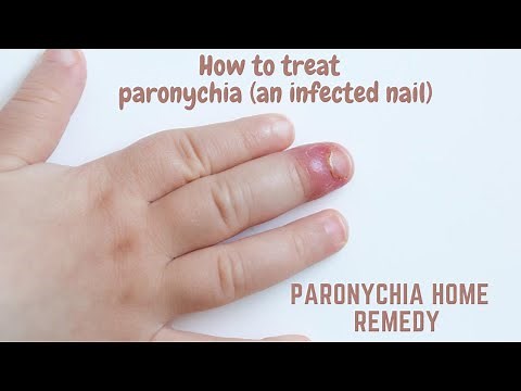 Paronychia home remedy | How to treat paronychia (an infected nail)