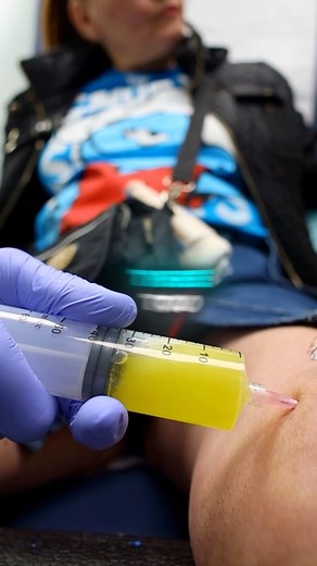 Knee aspiration, also known as joint drainage, is a procedure used to remove built-up fluid from the knee joint.A thin needle is carefully inserted to draw out the fluid, helping reduce swelling, relieve pain, and improve mobility.This procedure is often done for arthritis, injuries, or unexplained joint effusion, and can also be used to test the fluid for underlying conditions. #kneepain #painmanagement #painrelief | Precision Care Medical & Sports Performance