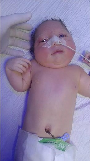 Microcephalic Baby – 2nd Day in NICU | Neonatal Care Update