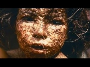 The Deadly Smallpox Virus Documentary History Channel