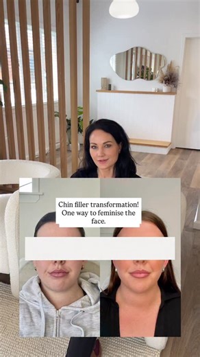 INJECTABLE COSMETIC NURSES & DOCTOR I Hamilton, NZ. on Instagram: "Chin filler transformation! Anna breaks down how she created this beautiful result using chin filler to make the facial structure appear more feminine and elongated, all balanced out with a little bit of lip filler to keep the facial harmony. #lipfiller #chinfiller #lipfillerbeforeandafter #beforeandafter #chin Dermal Filler, Medical Device Class Ill to smooth facial wrinkles and folds, correct facial atrophic scars, restore or e