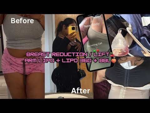 SURGERY VLOG | Breast reduction + lift, Arm lipo, Lipo360, Bbl… time for round 2!