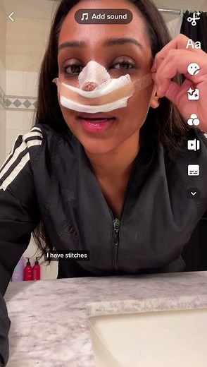 Rhinoplasty Recovery: Journey With Utah Facial Plastics #nosejob