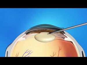 Cataract Surgery Animation