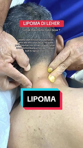 Understanding Lipoma: Causes, Symptoms, and Treatment Options