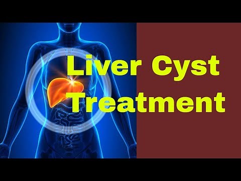 What are the Treatments for a Liver Cyst