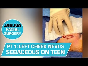 PART 1: LEFT CHEEK NEVUS SEBACEOUS ON TEENAGE GIRL - DR. TANVEER JANJUA - NEW JERSEY