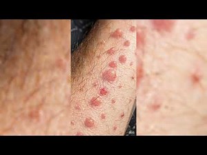 What Do Bed Bug Bites Look Like? Identification Guide