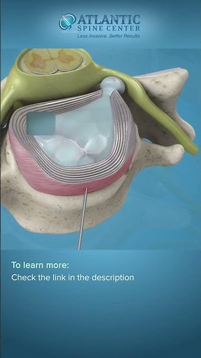 What is Endoscopic Anterior Cervical Discectomy? #shorts