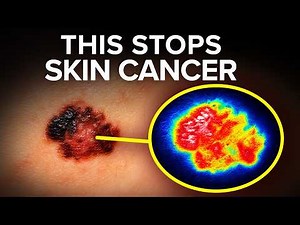Mole or MELANOMA?... We all NEED to know the difference