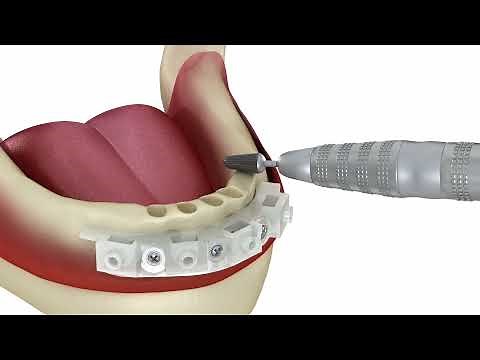 Full Arch Rehabilitation Using Anatomic Guide® Protocol