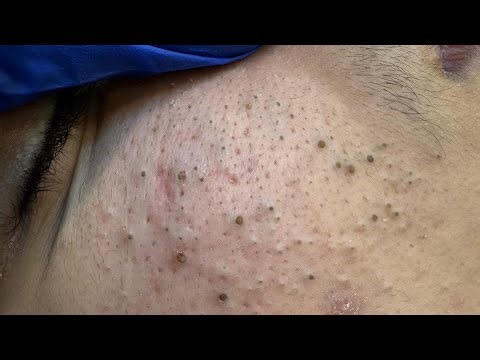 Facial Deep Cleanse — Ultimate Acne Treatment Techniques