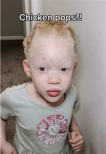 Chicken Pox Outbreak: Experiences and Relief Tips