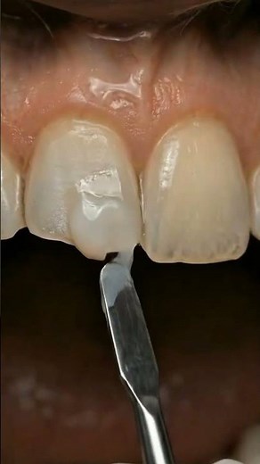 Restoring a Chipped Front Tooth: The Ultimate Transformation🤯👀