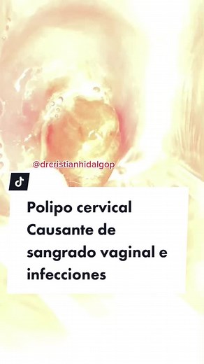 Polipos cervicales: síntomas y tratamientos efectivos