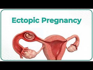 Ectopic Pregnancy: Classification, Pathogenesis, Clinical features, Diagnosis & Treatment
