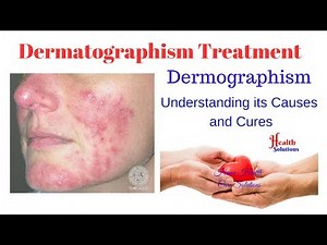 Dermatographism Treatment - Dermographism - Understanding its Causes and Cures