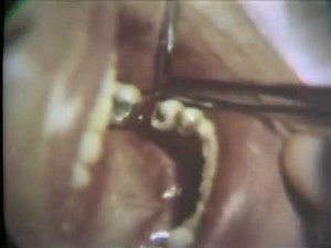 Bone Graft Into an Intrabony Pocket