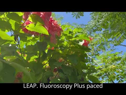 Traditional Pacemaker vs Transvenous LBBAP: Procedural Differences