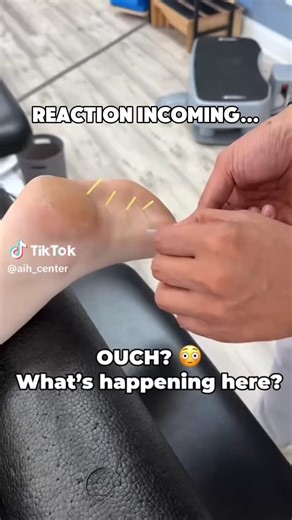 Feet First Clinic on Instagram: "Does dry needling for plantar fasciitis actually work? Hey Foot Fam, let’s talk about it 👣 Dry needling can be used to help release tight tissue in the foot and may help reduce inflammation. This often leads to quicker pain relief for people dealing with plantar fasciitis. It can be a helpful option for short term symptom relief. That said, dry needling does not treat the root cause of plantar fasciitis. If the condition is related to biomechanical issues such a