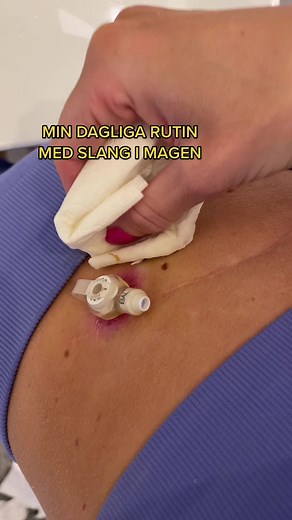 Medical Procedure Routine: Device Insertion and Removal