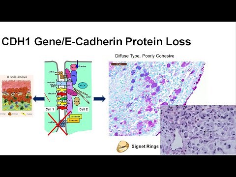 6 What is the Genetic Basis of GEC? Inherited vs Acquired CDH1 mutation/loss