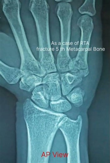 5th Metacarpal Fracture (Boxer’s Fracture) | Causes, Signs & Treatment in 30 Sec# RTA #health
