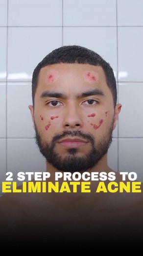 How to Clear Acne on Your Entire Face