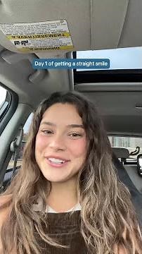 Quick Smile Makeover: 17-week Results | Motto Clear Aligners at Aspen Dental