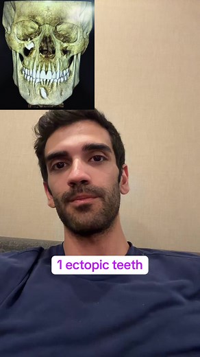 🎥 “7 Bizarre Teeth You Won’t Believe Exist 😱🦷” From vampire fangs to teeth in your nose — these real dental cases are WILD! Hit that follow for more strange human facts 👽 #BizarreTeeth #DentalFacts #WeirdTeeth #HumanBodyFacts #SharkTeeth #ToothTok #OddlySatisfying #FunFacts #MedicalTikTok #VampireTeeth #ToothTrivia #TikTokTeeth