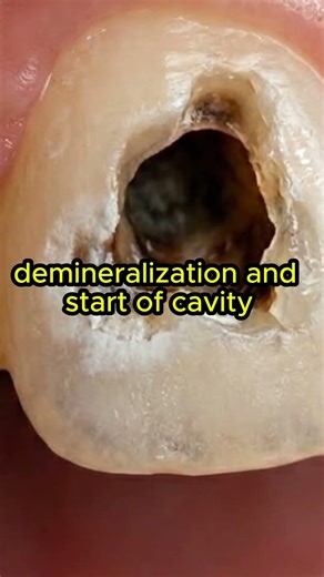 tooth decay stages #teethdecay #oralhealth
