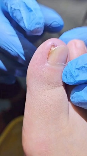 1.9M views · 10K reactions | #toenails #toes #feet #pedicure #nails #prettytoes #foot #footfetishnation #feetlovers #prettyfeet #feetworship #soles #feetpics #feetporn #toesfetish #feetfetishworld #softfeet #footfetish #footcare #barefeet #podiatrist #feetstagram #toe #cutefeet #pedicures #medical #reelsvideo #virals #followers #fyp | Emaly | Facebook