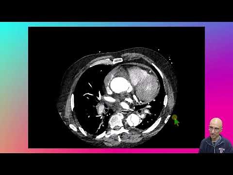 Type A Aortic Dissection with Shared Sheath Rupture