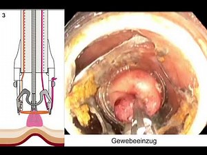 Colonic FTRD Steps OVESCO