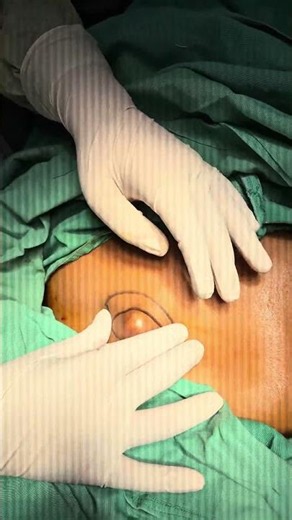 Sebaceous cyst