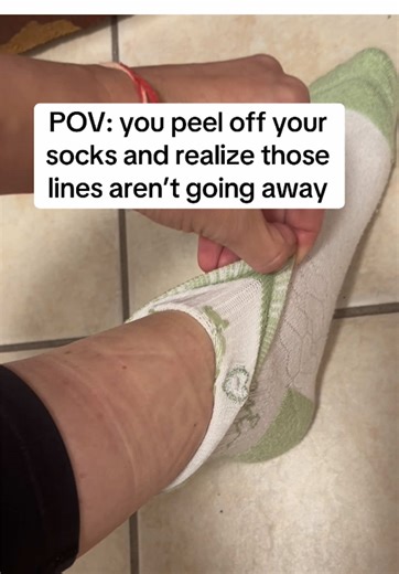 You can peel off your socks. The lines are deep. And they’re not going away. A faint imprint? Totally normal. But deep indents that last for minutes? That’s swelling, pressing against your socks. The sock didn’t cause it. It revealed it. Your legs are holding onto fluid your veins couldn’t pump back up. And those lines are proof. Do your sock marks look like this? ##sockmarks##circulation##leghealth##fluidretention##compressionsocks