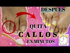 Treatment to remove calluses from my feet/Callus treatment at home