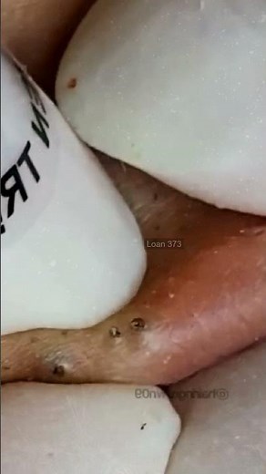 Happiness is pimples