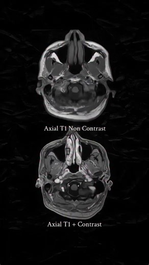 𝐑𝐓.𝐌𝐨𝐡𝐚𝐲𝐦𝐞𝐧 | Brain Tuberculosis Tumors: Comparison of Before and After Contrast MRI 💉 Axial T1 brain MRI of a patient with CNS tuberculosis,... | Instagram